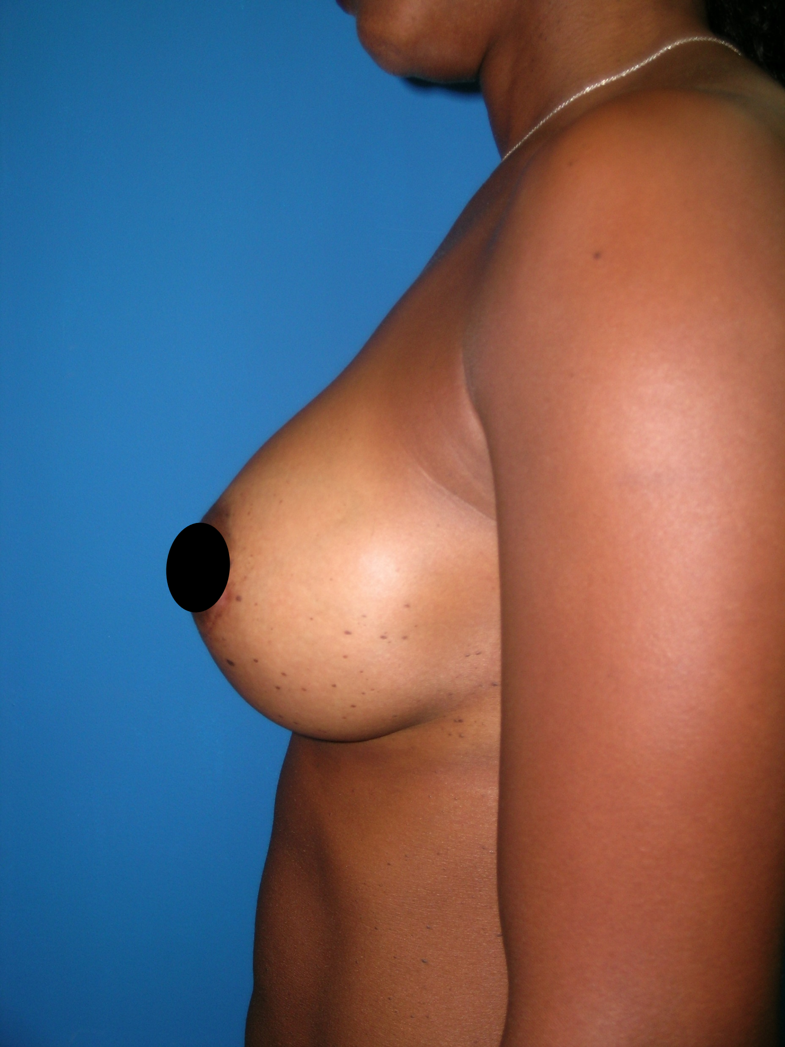 Aumento-Mamario-Despues-2.png