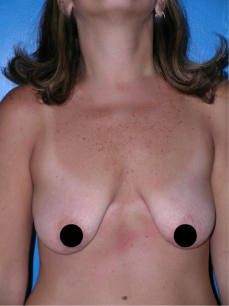 Breastlift-7-Antes.jpg