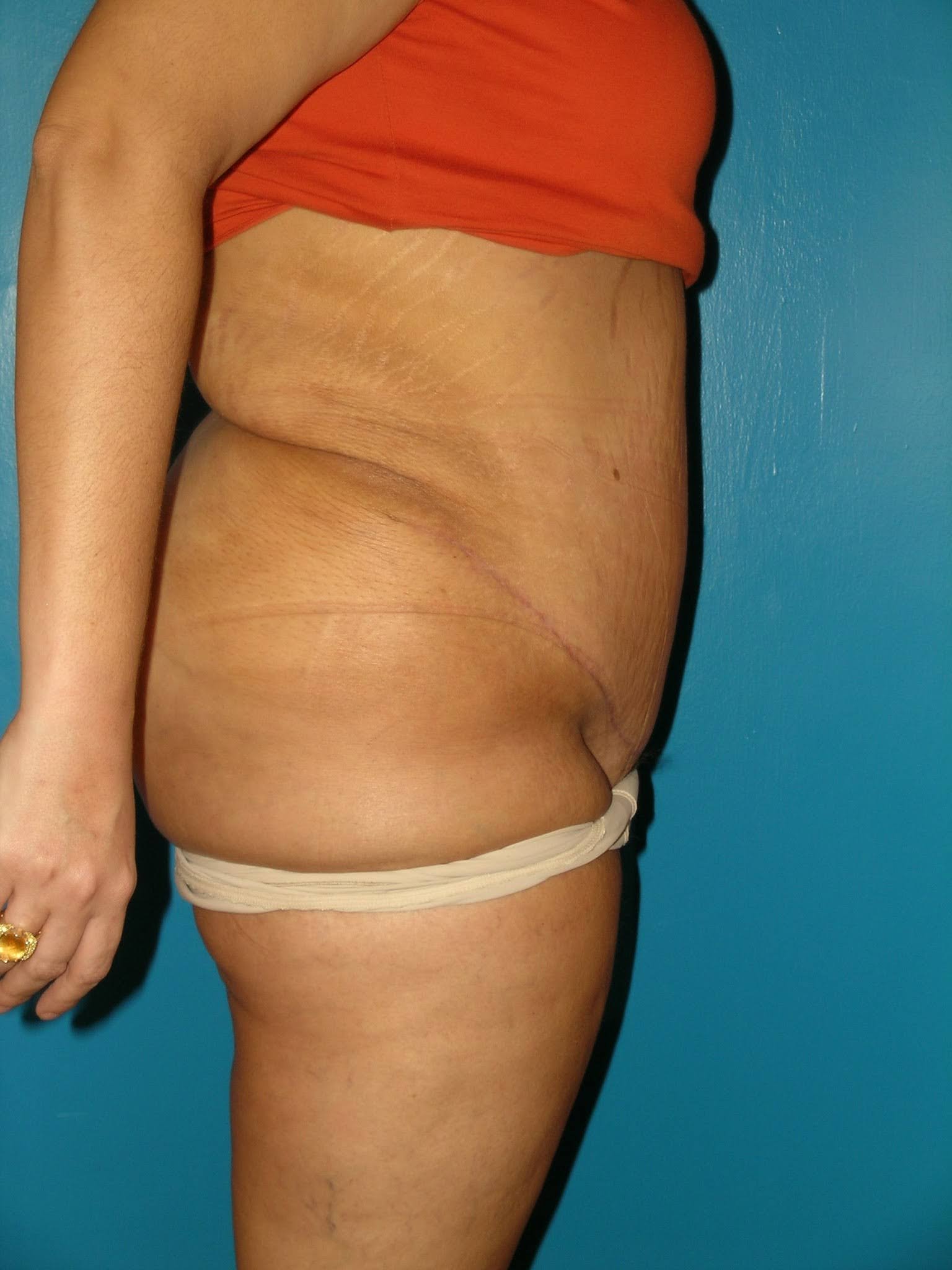 Dermolipectomia-despues.jpg